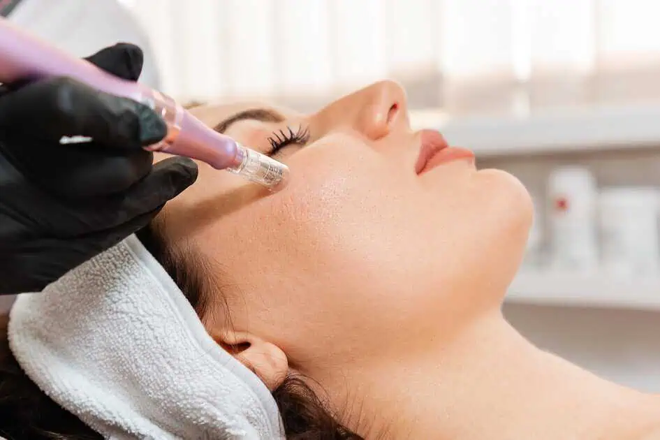 Procell Micro-Channeling in Meridian, ID by Sweet Cheeks Beauty Bar